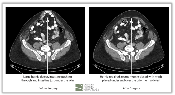 Recurrent Ventral Hernia CT Image